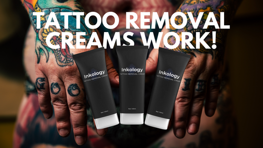 Tattoo Removal Creams Work and Here is How